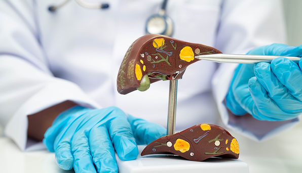 Memahami Batu Empedu agar Tidak Terlambat Ditangani